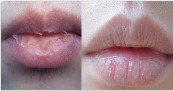 【終於找到嘴唇老是「乾裂脫皮」的原因！原來不是缺水，是因為……】